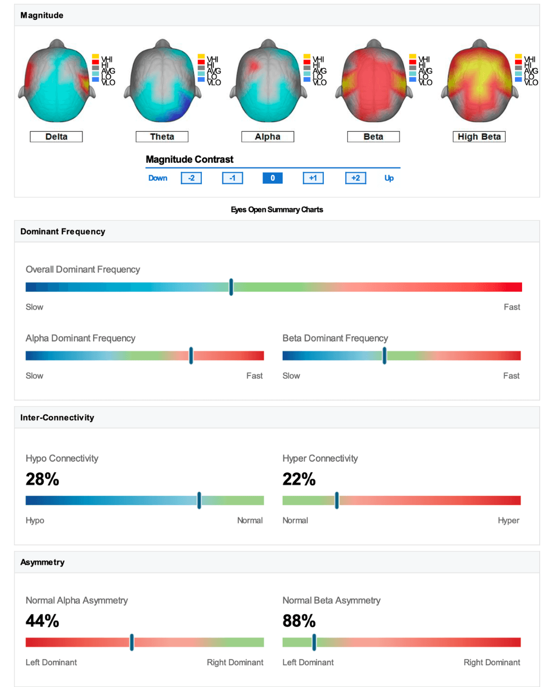 Sample qEEG brain map showing brainwave activity
